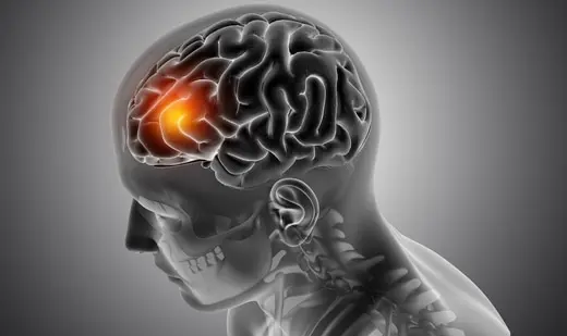 One of the signs of a brain tumour is a persistent headache. 