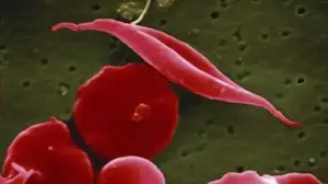 How sickle cell disease is diagnosed