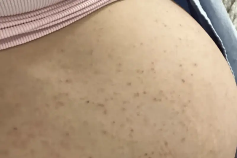 Robyn MacDonald-Camden's pregnant stomach covered in a red and itchy rash.