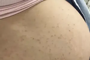 Pregnant woman gets biopsy for rash, never expected what it would reveal