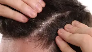 Dandruff is not just about poor hygiene: Dermatologist explains its link with scalp infections, diet, and overall health