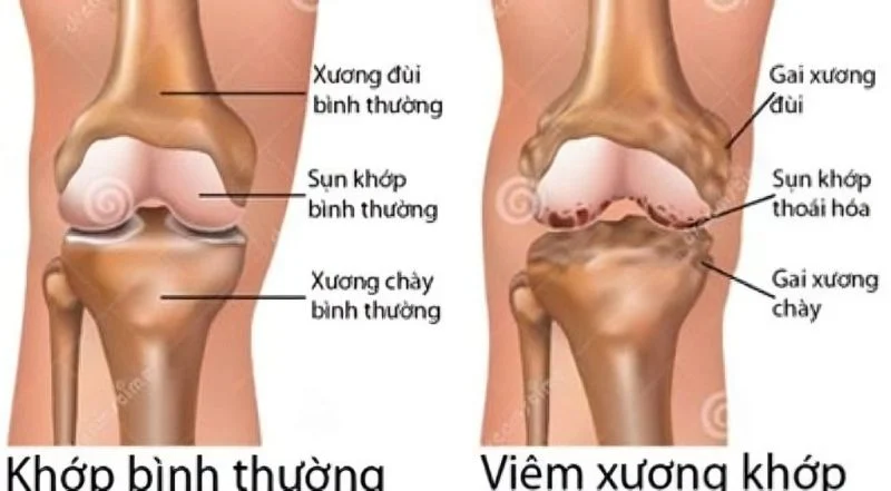 Cách uống nước nghệ tươi giảm axit uric- Ảnh 1.