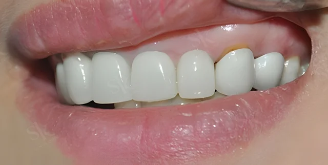 Viêm nướu sau bọc răng sứ chủ yếu do kỹ thuật và chăm sóc không đúng cách.