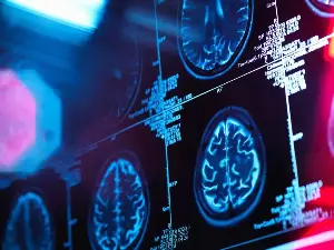 Millions of adults have this common condition. It’s linked to cognitive decline