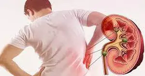 How long does it take for kidney stones to pass out on their own, and when is intervention necessary?