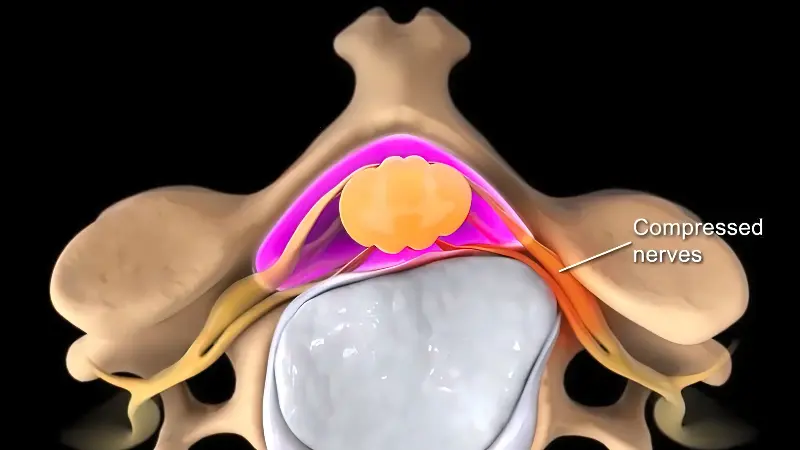 medical illustration showing spinal disc pressing on compressed nerves causing back pain