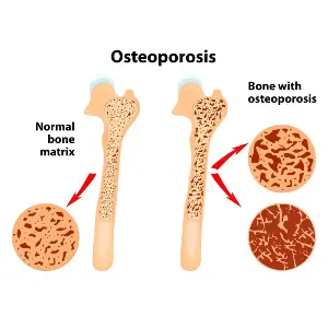 Exercise remains crucial part of bone health
