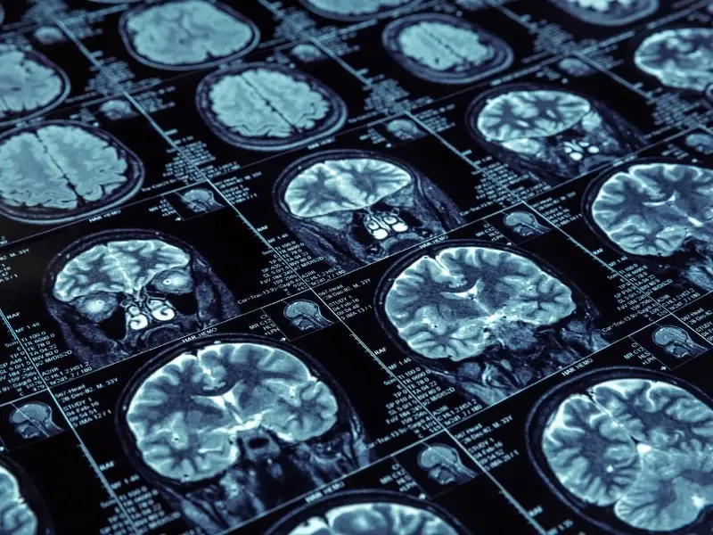 A closeup of magnetic resonance imaging of the brain.