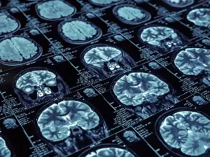 Scientists investigated people with insomnia. A health risk pattern emerged