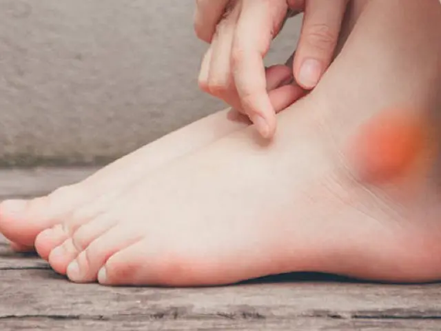 Swollen ankles: 4 dangerous diseases you may have - Photo 1. Sưng phù mắt cá chân: 4 căn bệnh nguy hiểm có thể đang mắc- Ảnh 1.