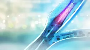 Wrist vs groin: Know all about angioplasty that will change how you think about recovery