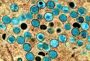 Mandaluyong logs mpox case, DOH assures no outbreak