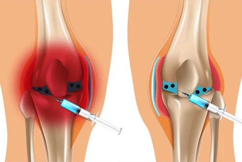 Chọc hút sẽ giúp giảm nhẹ các triệu chứng cho bệnh nhân. Ảnh minh họa