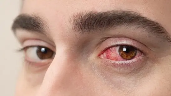 Do not try to self-treat any eye-related problems, like redness or itching. Visit a doctor instead. 