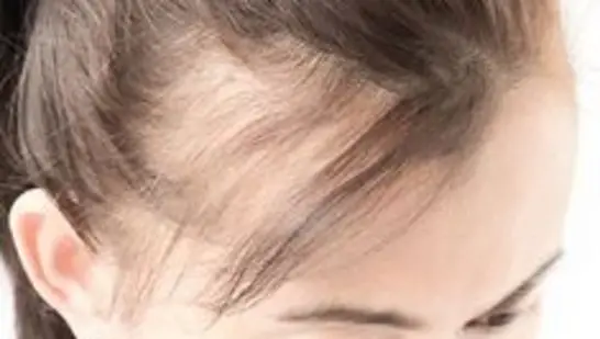 Losing hair in your teens? Here’s why and how to stop it before it’s too late 