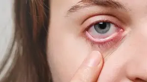 Eye injury first aid: Doctor shares steps to take if dust gets in your eye or a ball hits it