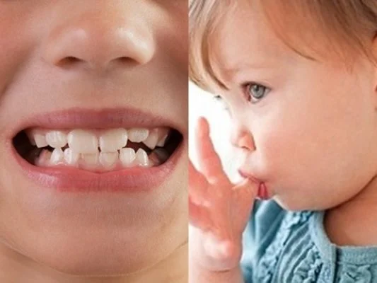 Điều trị sớm khớp cắn ngược răng sữa ở trẻ- Ảnh 1.